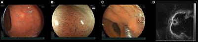 Underwater Endoscopic Mucosal Resection of Small Rectal Neuroendocrine Tumors